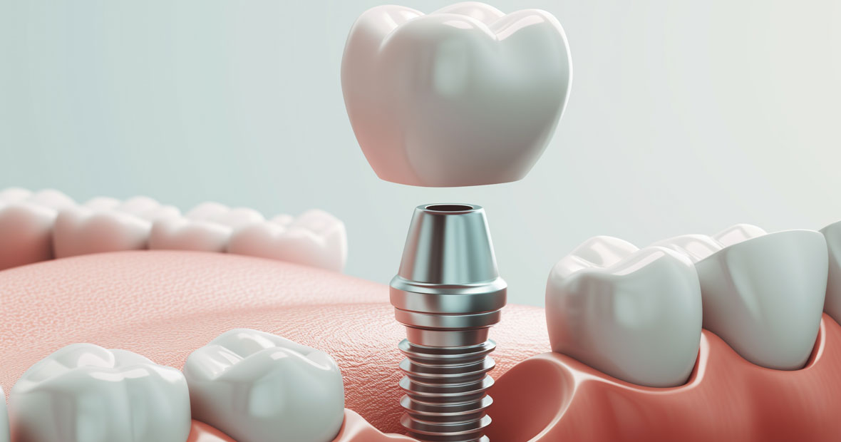 implant dentaire